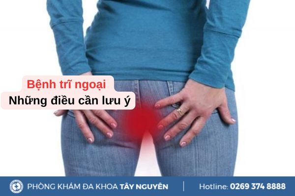 Bệnh trĩ ngoại và những điều cần lưu ý
