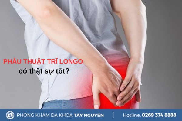 Phương pháp phẫu thuật trĩ Longo có thật sự tốt?