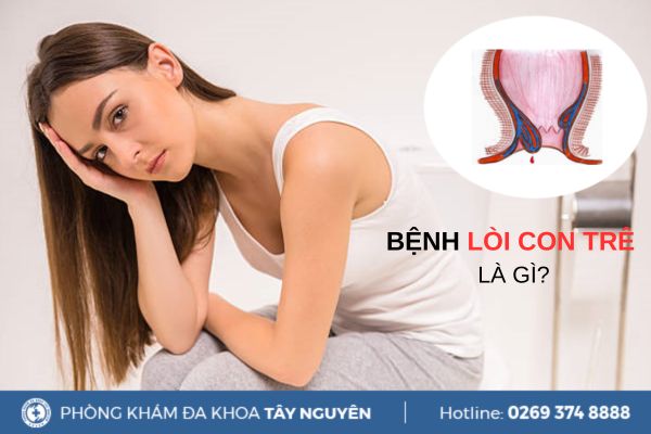 Bệnh lòi con trê là gì? Phương pháp điều trị bệnh hiệu quả