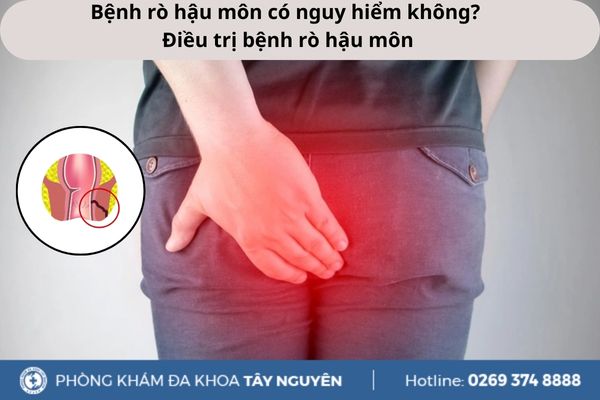 Bệnh rò hậu môn có nguy hiểm không? Điều trị bệnh rò hậu môn