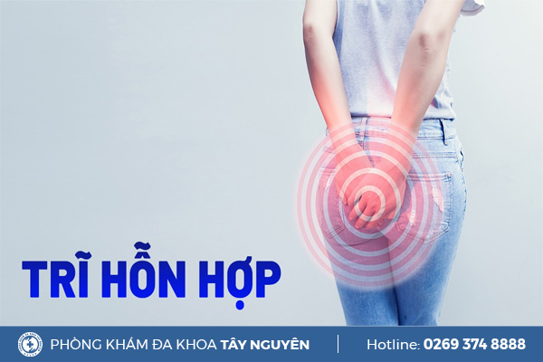 Bệnh trĩ hỗn hợp và phương pháp điều trị bệnh