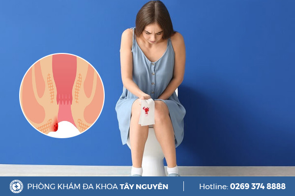 Bị trĩ lòi thịt phải làm sao?