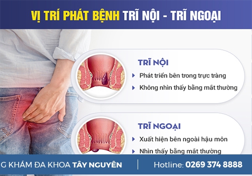 Dấu Hiệu Bị Trĩ  Và Cách Điều Trị Hiệu Quả