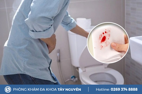 Đi cầu ra máu tươi là do đâu? Làm sao điều trị khỏi?
