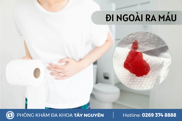 Chữa khỏi đi ngoài ra máu do các bệnh hậu môn trực tràng