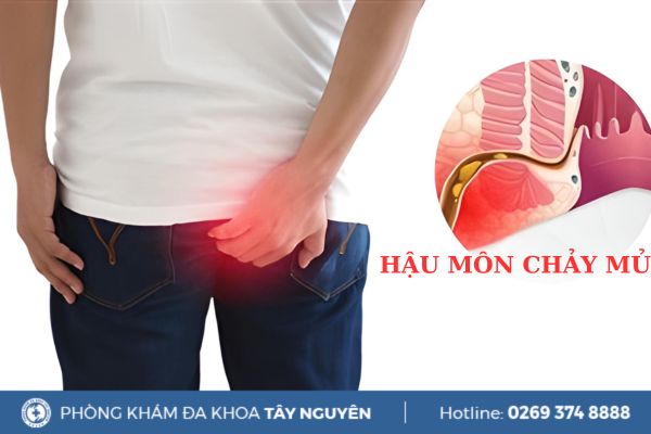 Hậu môn chảy mủ dấu hiệu bệnh lý gì