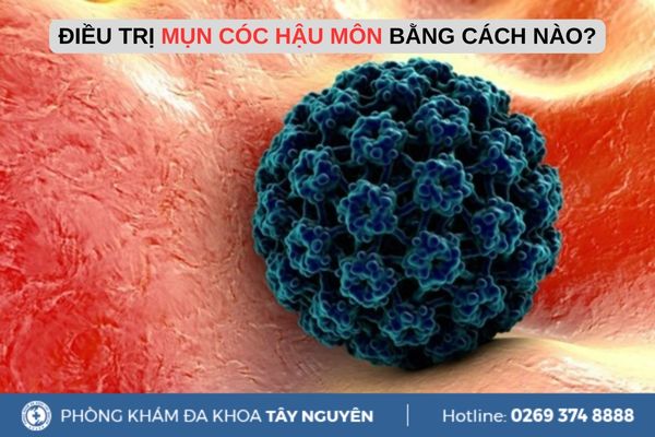 Hậu môn nổi mụn cóc là bệnh gì? Điều trị bệnh mụn cóc như thế nào?