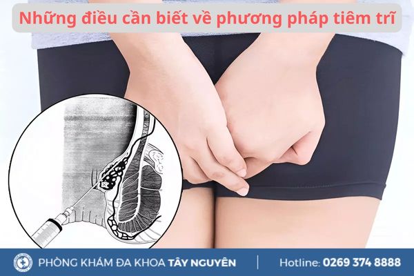 Những điều cần biết về phương pháp tiêm trĩ