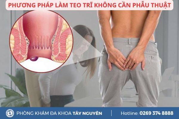 Phương pháp làm teo trĩ không cần phẫu thuật
