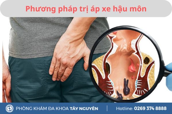 Phương pháp trị áp xe hậu môn hiệu quả, an toàn