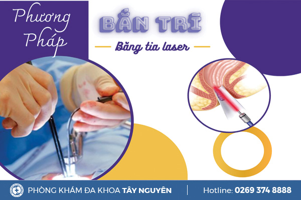 Bắn trĩ bằng tia laser là gì? Quy trình bắn trĩ diễn ra như thế nào?