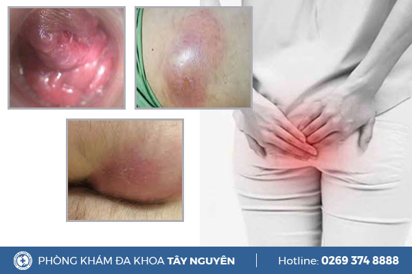 Sưng hậu môn và phương pháp điều trị hiệu quả