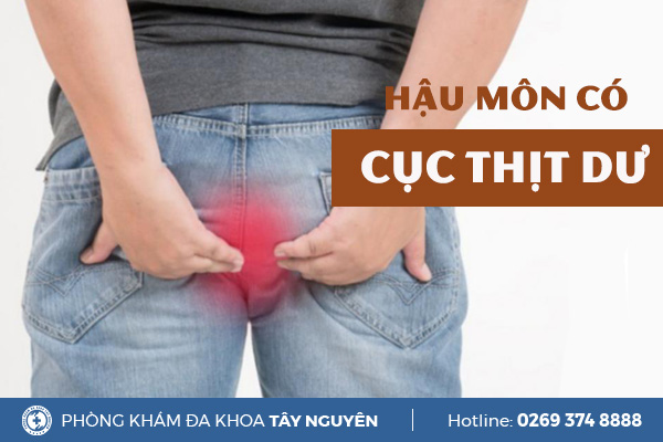 Hậu môn có cục thịt dư là bị gì? Chữa trị như thế nào?