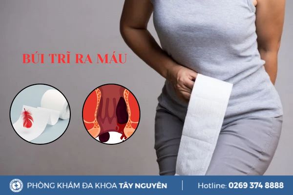 Hiện tượng búi trĩ ra máu có nguy hiểm không?