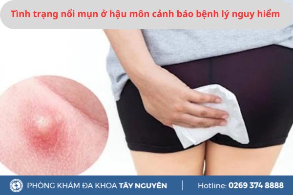 Tình trạng nổi mụn ở hậu môn cảnh báo bệnh lý nguy hiểm nào?